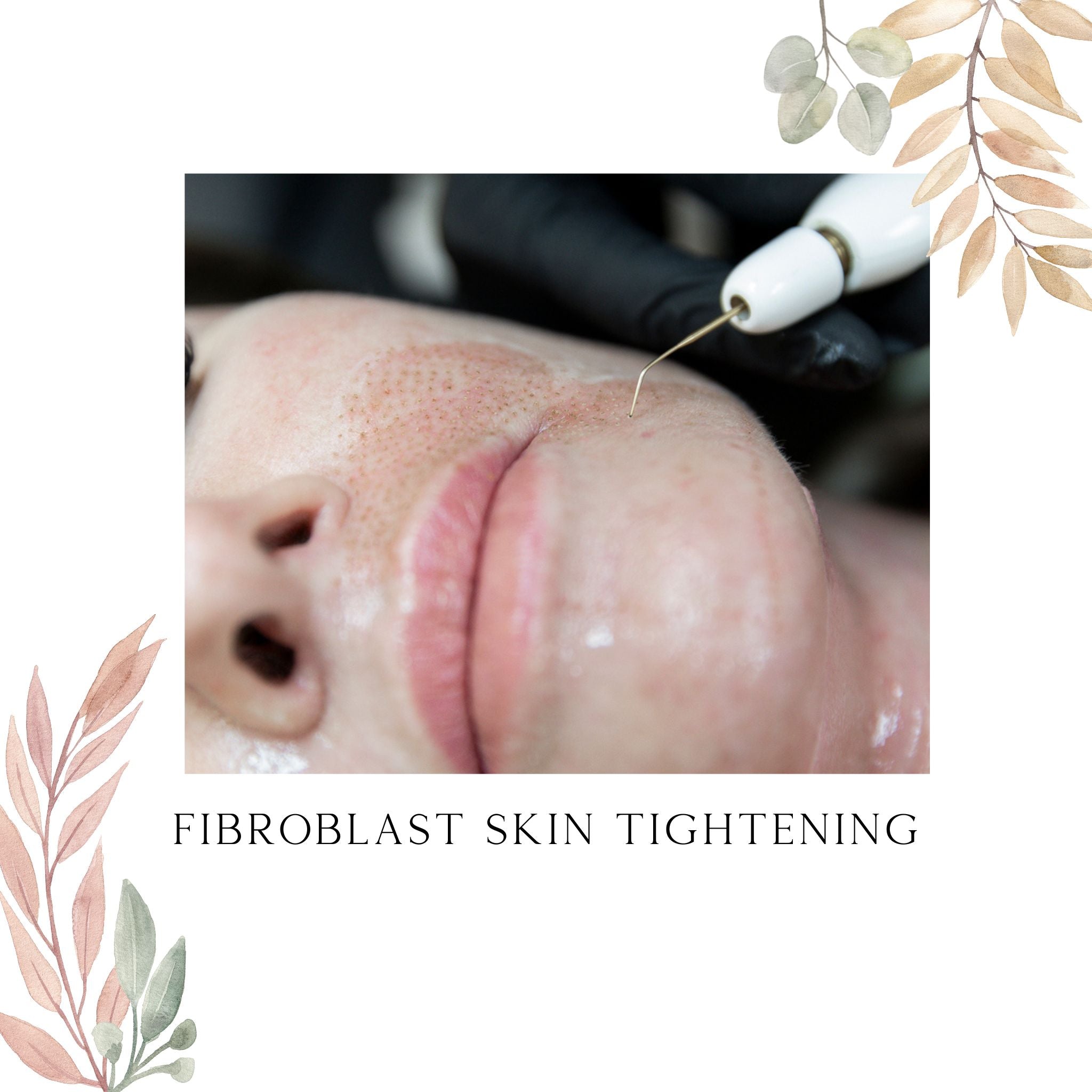 Fibroblast Skin Tightening