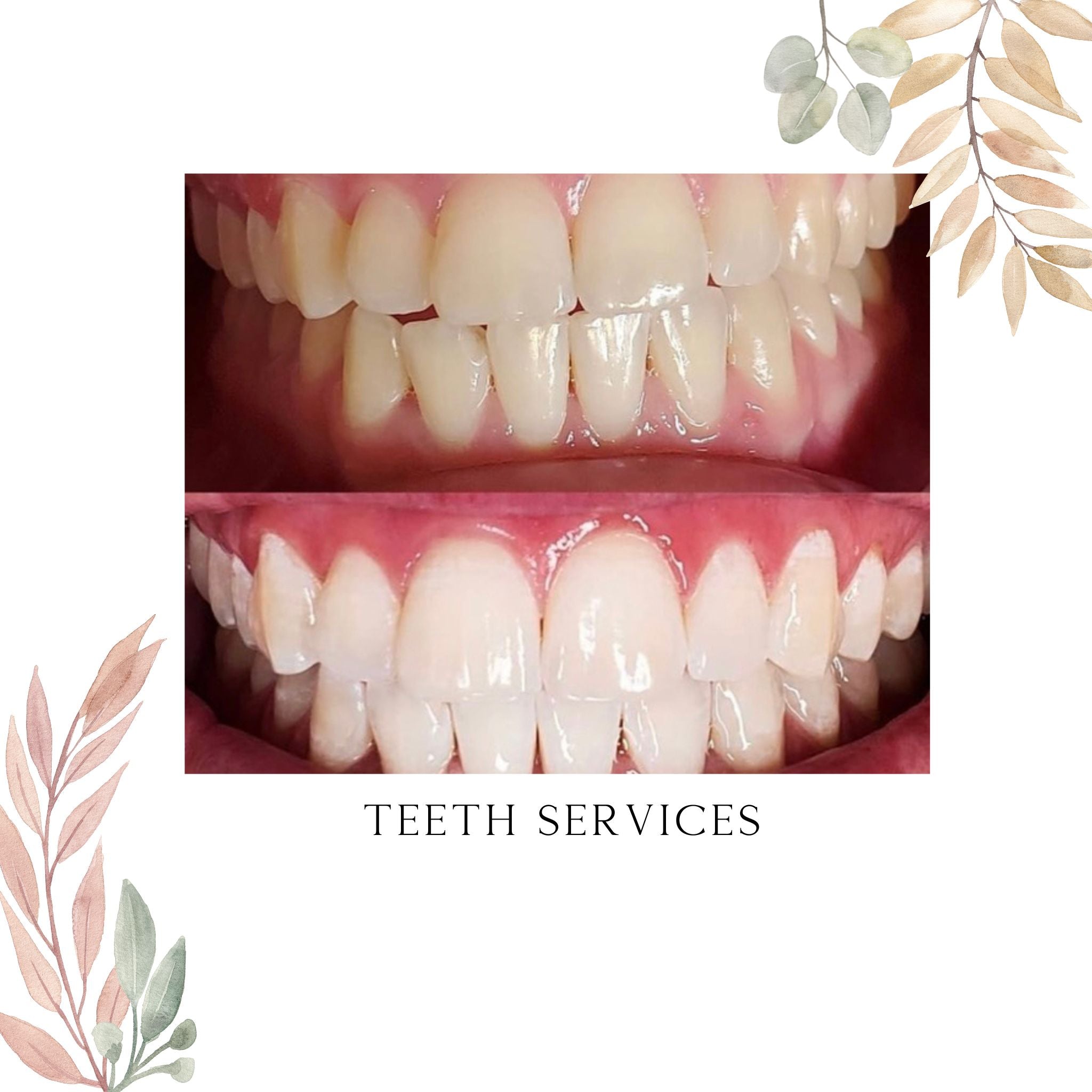 Teeth Services