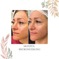 SkinPen Microneedling (Click to see Options)