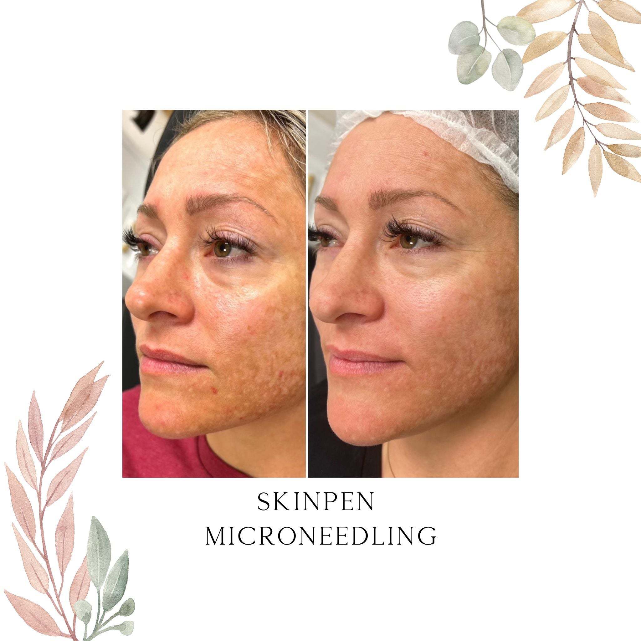 SkinPen Microneedling (Click to see Options)