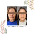 HIFU Skin Tightening (Click to see options)
