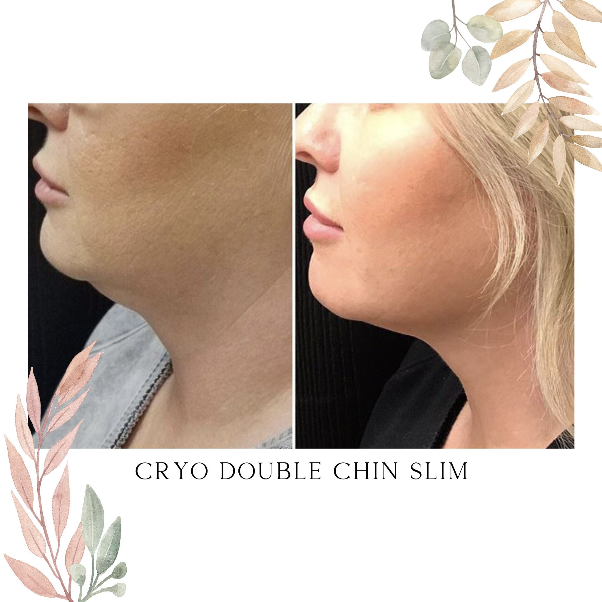Cryo Double Chin Slim
